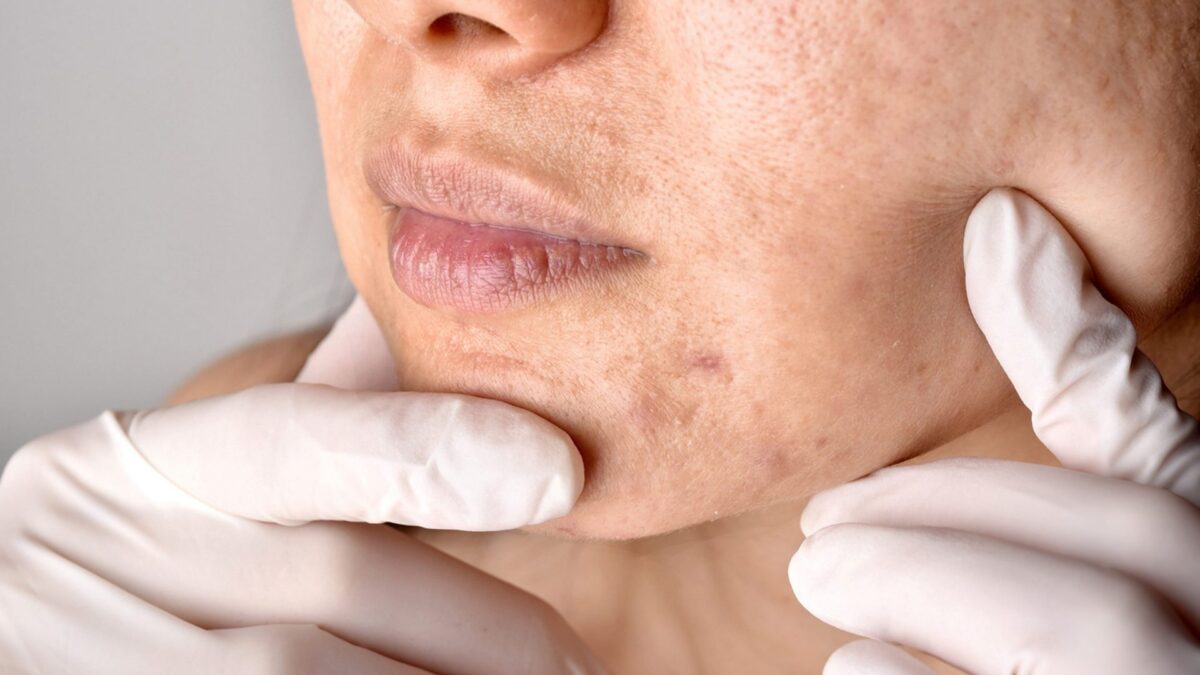 Harnessing Pico Laser’s Power Against Stubborn Acne Scars