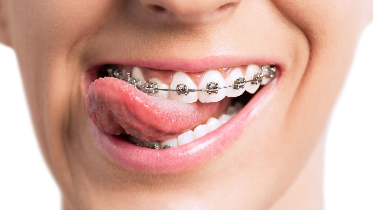 Keeping Your Dental Hygiene Strong Even After Wearing Traditional Braces: 6 Tips