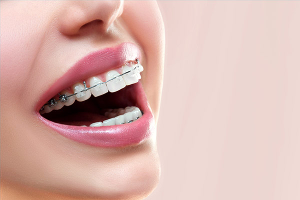 orthodontic braces