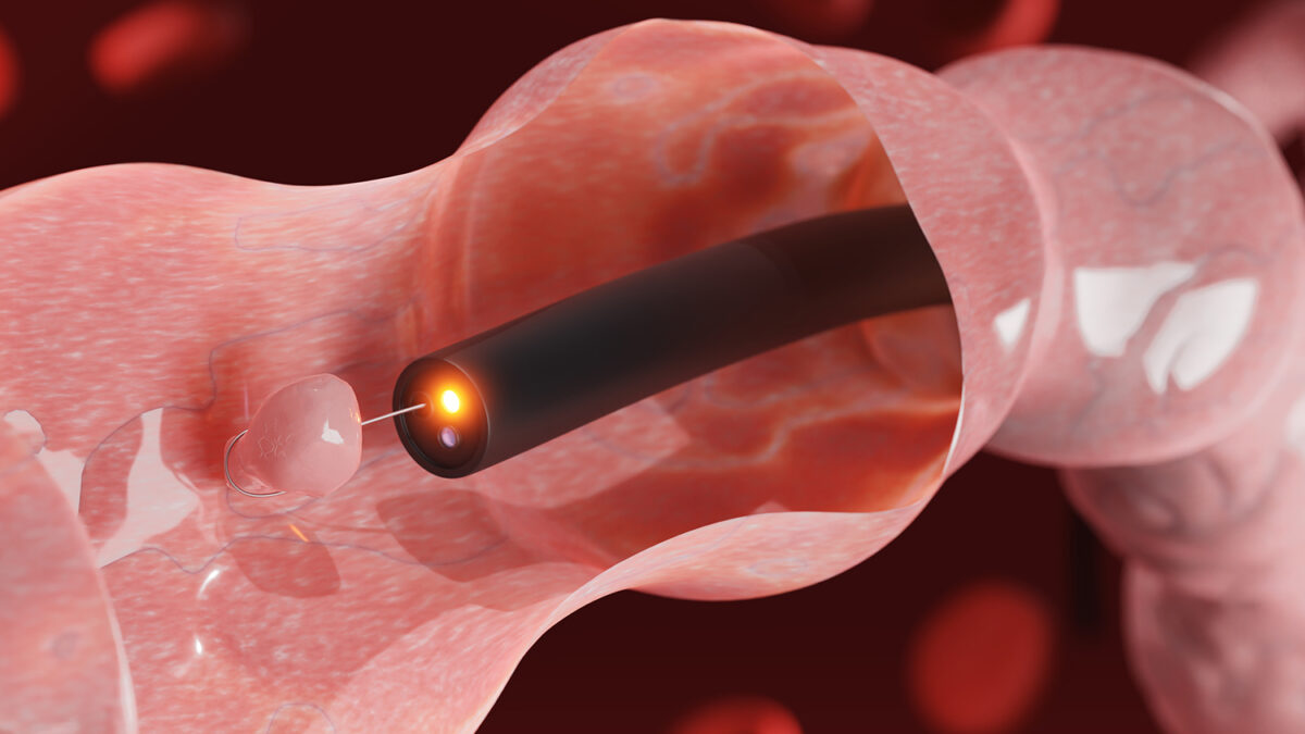 The Importance of Endoscopy in Detecting Stomach Ulcers