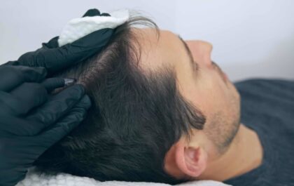 scalp micropigmentation help you to have a fuller hairline